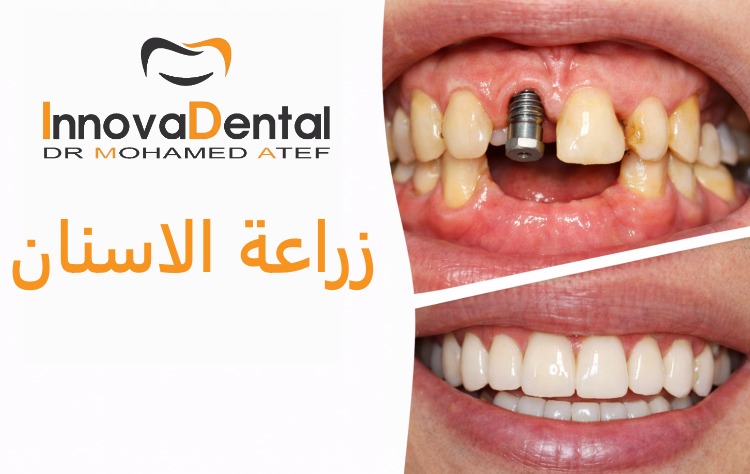 زراعة الاسنان في مركز Innova: الحل الأمثل لاستعادة الابتسامة